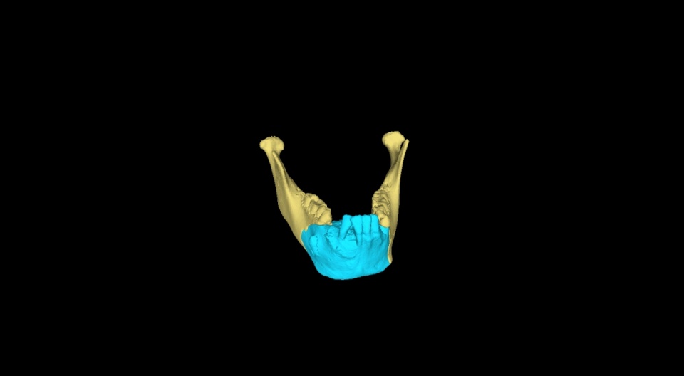 Przy planowaniu operacji chirurdzy użyli wydrukowanego modelu kości w 3D. Fot. Mat. Samodzielnego Publicznego Szpitala Klinicznego na Pomorzanach w Szczecinie.