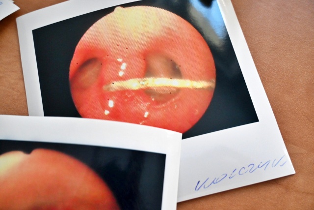 Fot. Samodzielny Publiczny Wojewódzki Szpital Zespolony Co znajdują lekarze w oskrzelach pacjentów? Zęby, zakrętki, gwoździe i żywność [ZDJĘCIA]