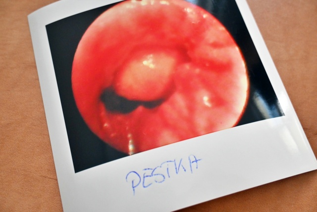 Fot. Samodzielny Publiczny Wojewódzki Szpital Zespolony Co znajdują lekarze w oskrzelach pacjentów? Zęby, zakrętki, gwoździe i żywność [ZDJĘCIA]