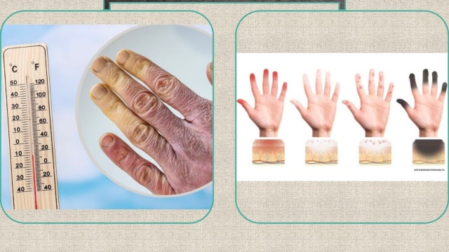 Odmrożenia i poparzenia najczęściej zagrażają bezdomnym zimą. Ratownicy codziennie interweniują, w skrajnych przypadkach dochodzi do amputacji. Służby pomagające osobom w kryzysie bezdomności apelują o zgłaszanie sytuacji zagrożenia zdrowia lub życia.